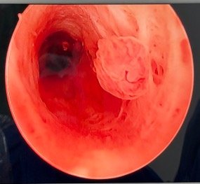 pólipo endometrial
pólipo endocervical 