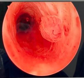 pólipo endometrial
pólipo endocervical
