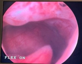 histeroscopia e mioma submucoso
mioma uterino

