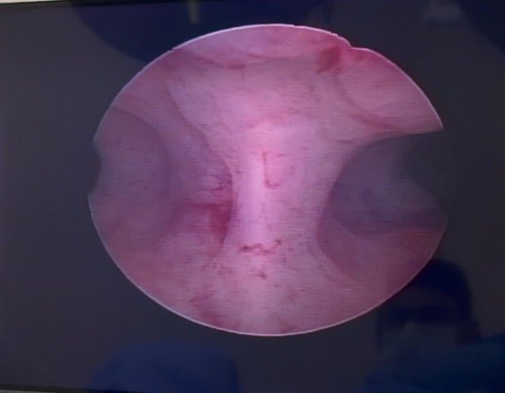 histeroscopia diagnóstica
septo uterino
histeroscopia com septo