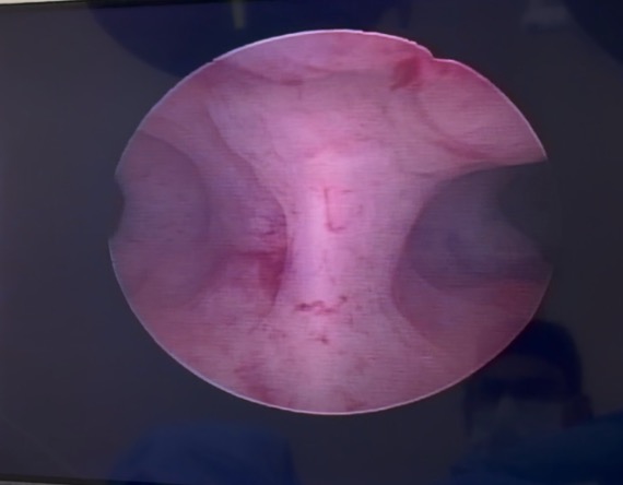 histeroscopia diagnóstica
septo uterino
histeroscopia com septo
