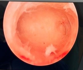 cavidade uterina
histeroscopia diagnóstica
utero normal