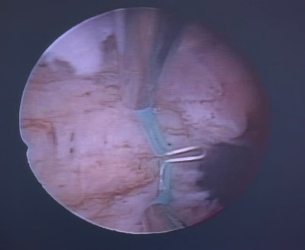 histeroscopia cirurgica
septoplastia