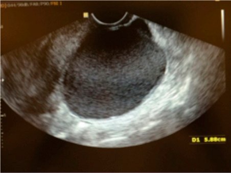 ultrassom com endometrioma
endometrioma volumoso
endometrioma grande
ultrassom transvaginal com preparo intestinal
ultrassom mapeamento