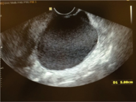 ultrassom com endometrioma
endometrioma volumoso
endometrioma grande
ultrassom transvaginal com preparo intestinal
ultrassom mapeamento
