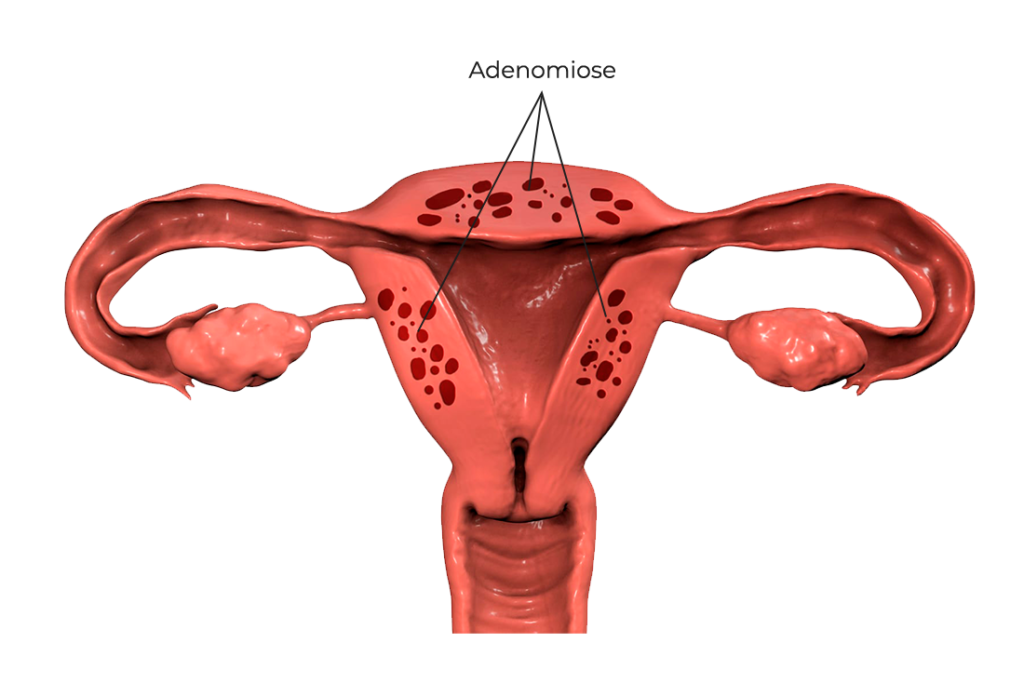 adenomiose
adenomiose infiltrativa
adenomiose difusa
adenomiose focal
adenomiose e aumento do utero