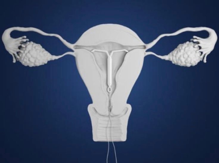 endometriose e diu de mirena
adenomiose e diu de mirena
diu levonogestrel
diu mirena
útero com diu levonogestrel