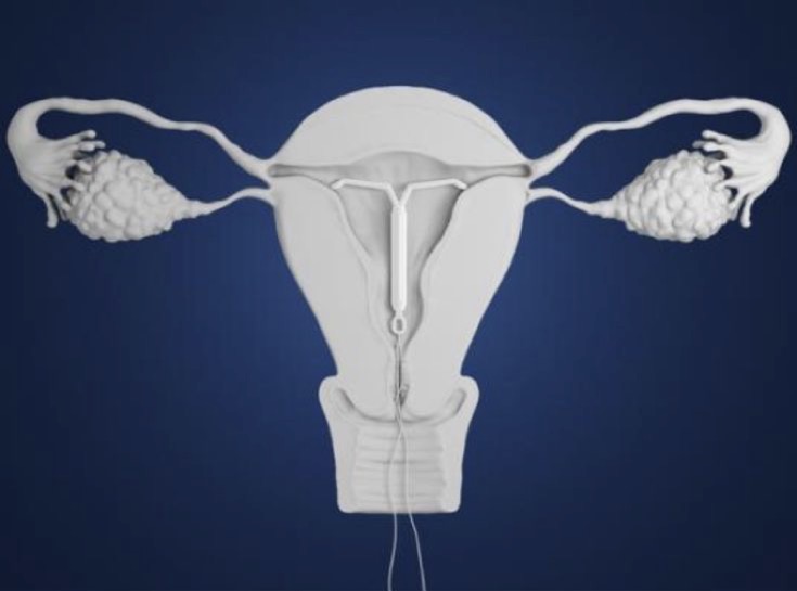 endometriose e diu de mirena
adenomiose e diu de mirena
diu levonogestrel
diu mirena
útero com diu levonogestrel