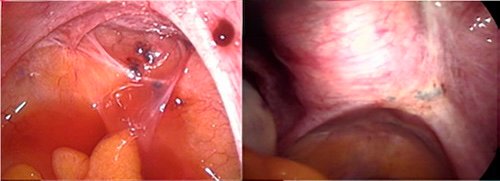 endometriose peritoneal
endometriose profunda
laparoscopia com endometriose
endometriose em ligamento uterossacro
endometriose infiltrativa