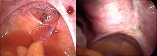 endometriose peritoneal
endometriose profunda
laparoscopia com endometriose
endometriose em ligamento uterossacro
endometriose infiltrativa