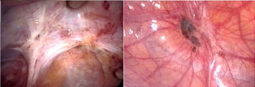 endometriose peritneal profunda
aderências pélvicas
endometriose e aderência
