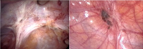 endometriose peritneal profunda
aderências pélvicas
endometriose e aderência