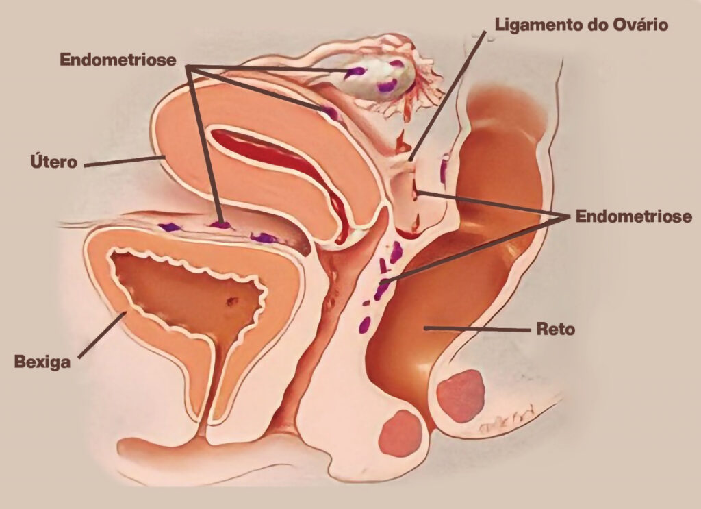 Ilustração da endometriose
pelve com endometriose
endometriose profunda
