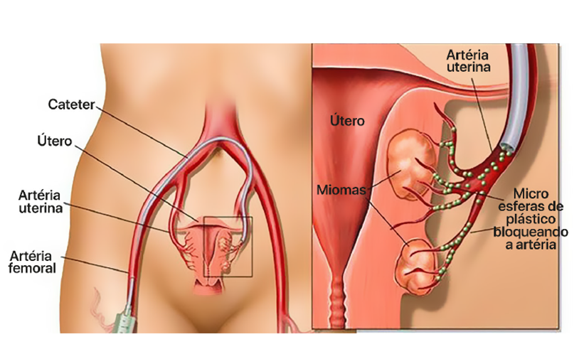 embolização
artéria uterina
miomas