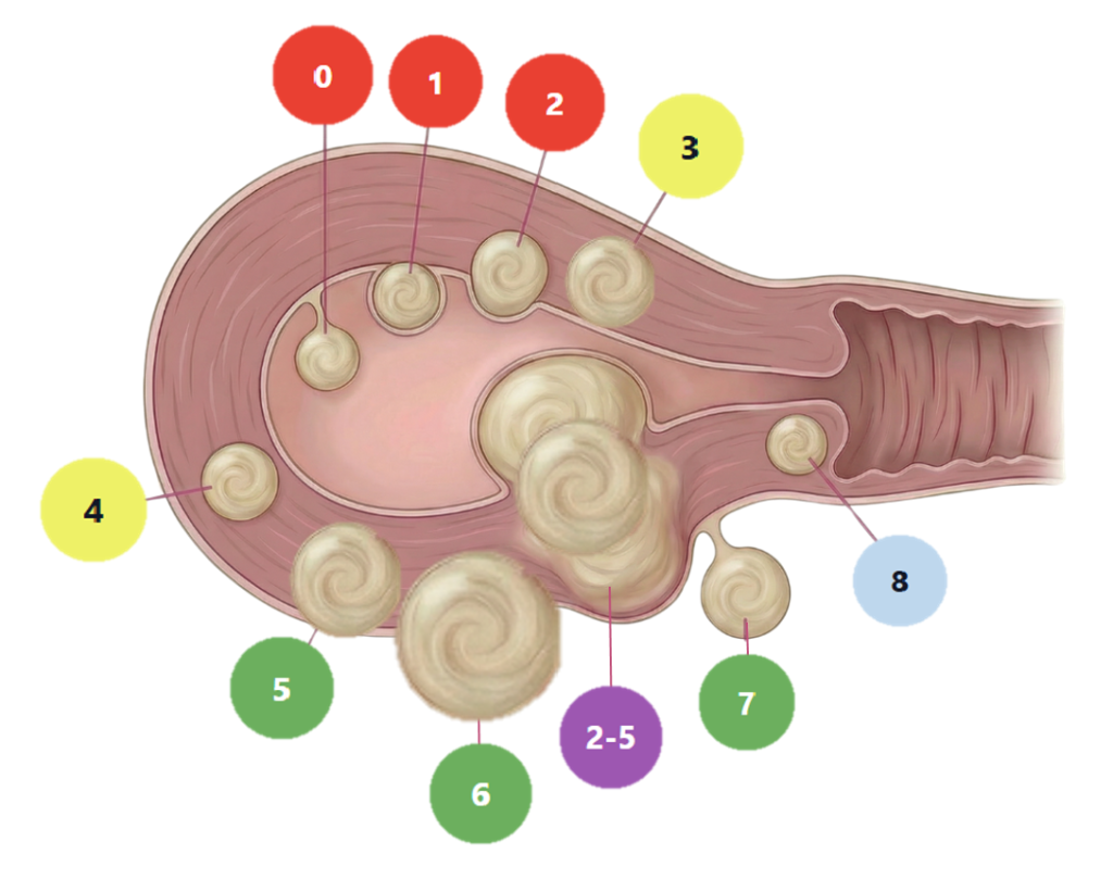 classificação figo para miomas
FIGO
tipos de miomas
miomas uterino
miomas no útero
mioma