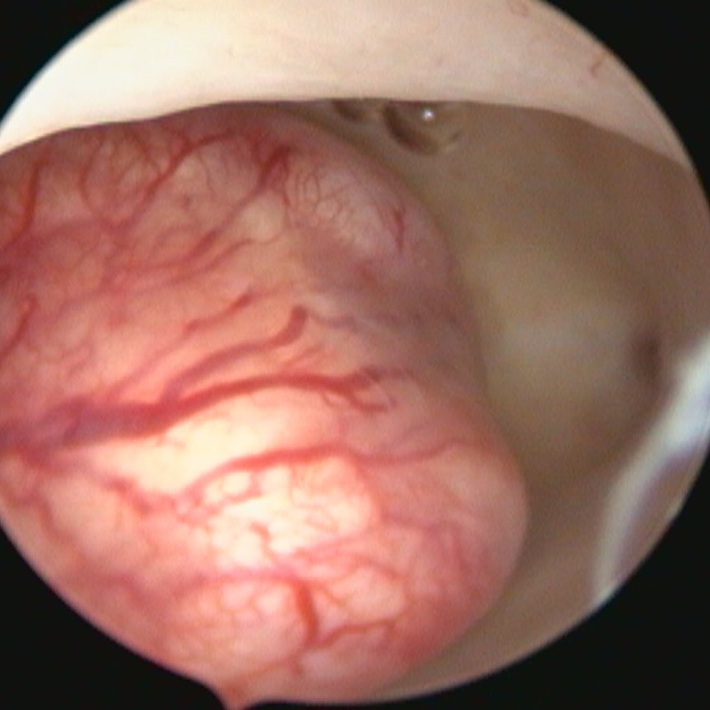histeroscopia
histeroscopia cirúrgica
miomectomia histeroscópica
mioma submucoso