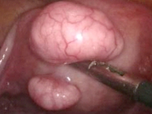 laparoscopia
miomectomia laparoscópica
mioma subseroso
videocirurgia