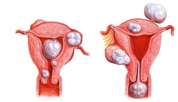 localização dos miomas
tipos de miomas
mioma
miomas
mioma parido
mioma pediculado