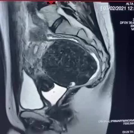 ressonância pélvica
mioma na ressonância
imagem de mioma na ressonância
mioma volumoso