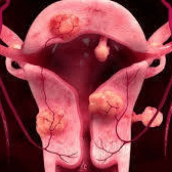 fluxo sanguíneo do útero
miomas
irrigação uterina