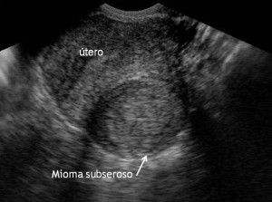 ultrassom com mioma
ultrassonografia transvaginal
mioma no ultrassom