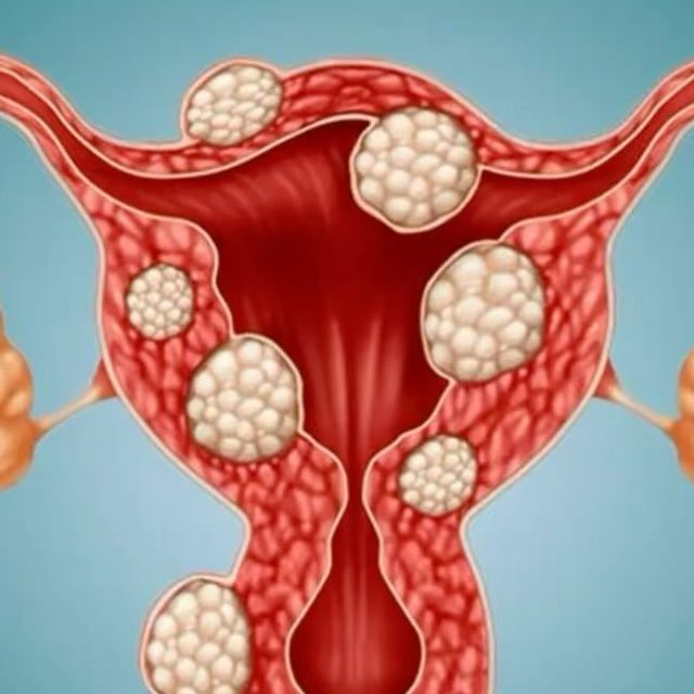 utero miomatoso
útero com miomas
útero doente 
mioma